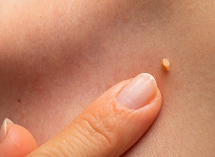 Lógó szemölcs, futószemölcs, közönséges szemölcs: hogyan lehet eltávolítani őket? című cikk nyitóképe