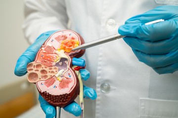 Mitől alakul ki a vesekő?