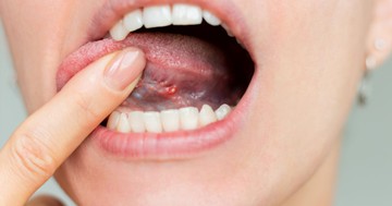 A nyelve is árulkodhat: 9 szájüregi tünet, amely B12-vitamin-hiányra figyelmeztethet