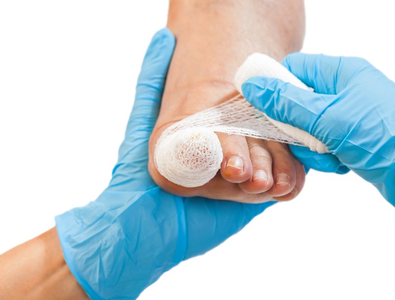 köröm, körömleválás, orvos válaszol, körömágy-gyulladás