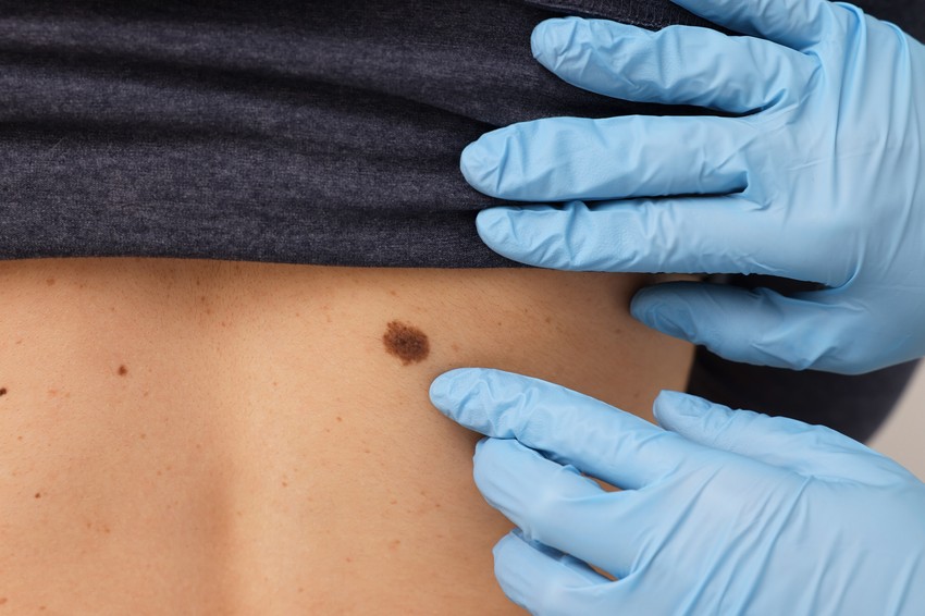 A noduláris melanoma a melanomák legagresszívebb típusa, amely gyorsan terjed, és gyakran csak az utolsó pillanatban diagnosztizálják.