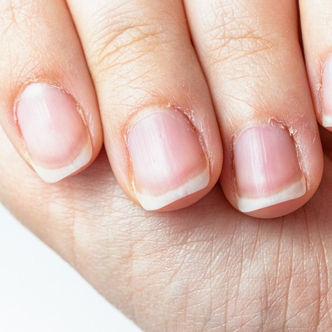 Berepedezik a körömágya? Így ápolja a bőrét, hogy megelőzze a fájdalmat  című cikk nyitóképe