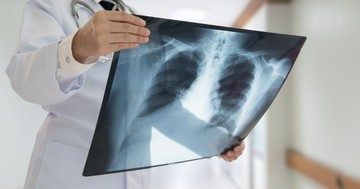 Az orvos elárulja, hogy mit tegyen a COPD-s beteg, ha fellángolnak a tünetei