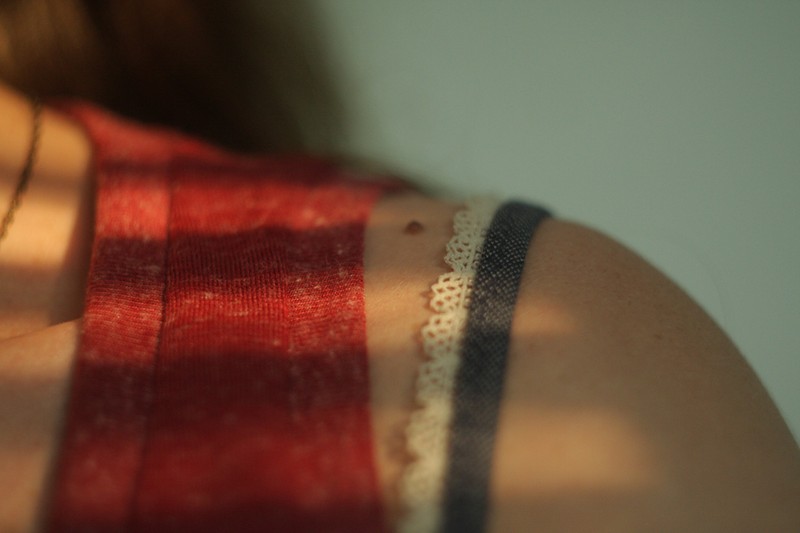 Mikor szabad napra menni anyajegy eltávolítás után? Ezt mondja a bőrgyógyász