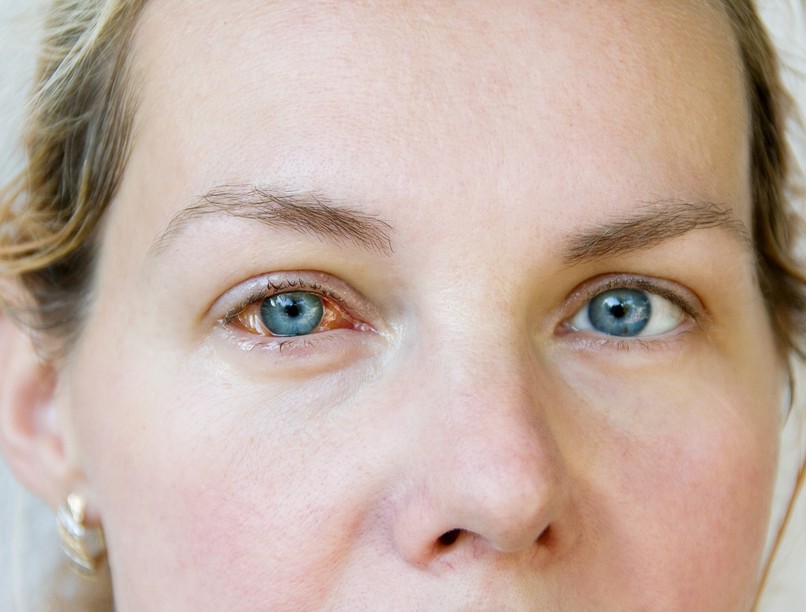 kötőhártya-gyulladás meddig fertőz