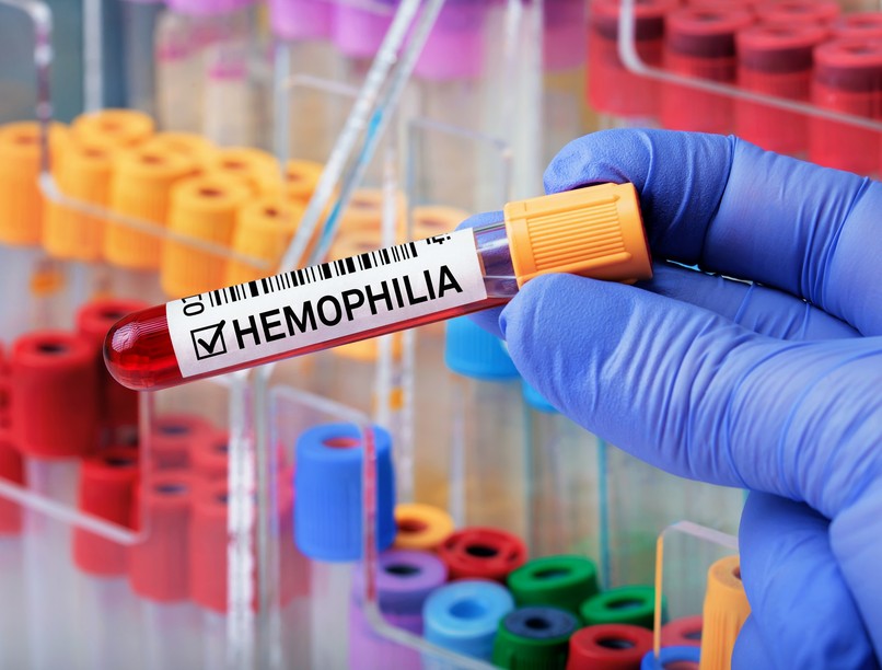hemofília, vérzékenység, véralvadási zavar