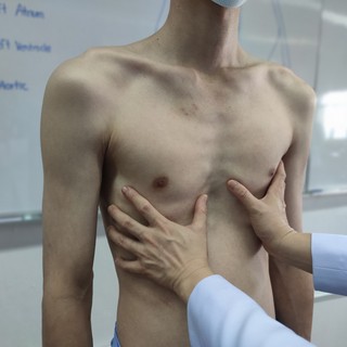 Mellkas deformitások tünetei, vizsgálata és kezelése című cikk nyitóképe