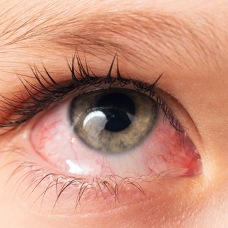 Mennyi idő alatt múlik el a kötőhártya gyulladás? című cikk nyitóképe