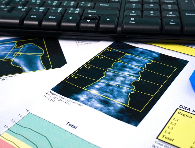 csontritkulás csontsűrűség mérés vizsgálat