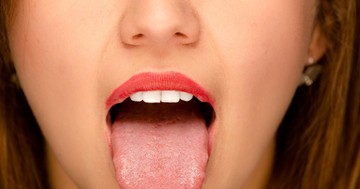  Miért lepedékes a nyelvünk, mikor jelezhet betegséget? 