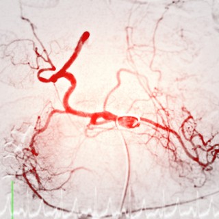Mi az arteriográfia és mit mutat ki? című cikk nyitóképe