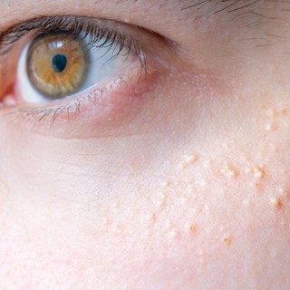 Mik azok a kis, fehér, kidudorodó pöttyök a bőrön? című cikk nyitóképe