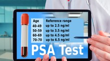 Mi a normális PSA-szint életkor szerint? Ezt jelzik a csillagos eltérések a leleten című cikk nyitóképe