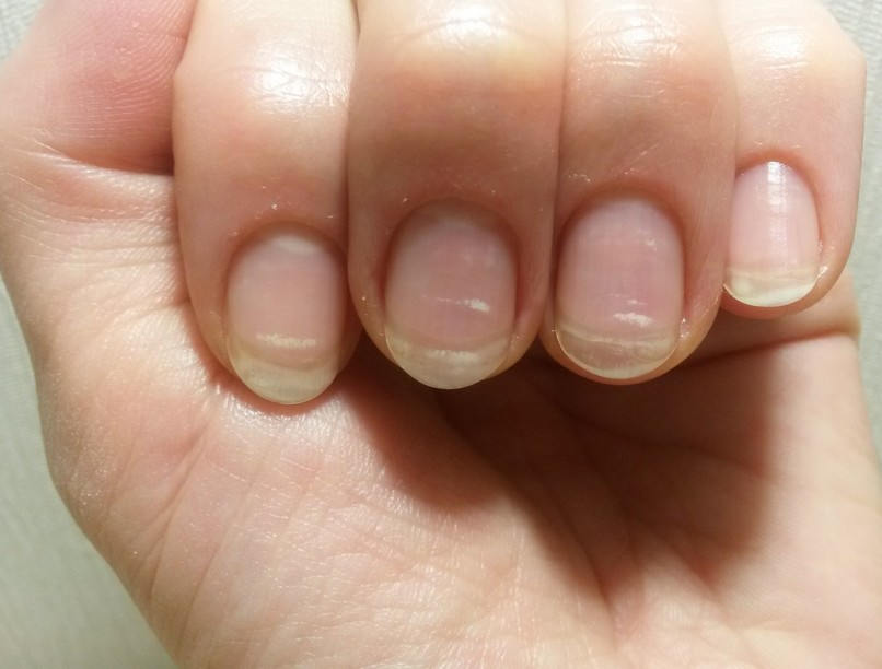 köröm, törékeny, csík, pötty, mélyedés