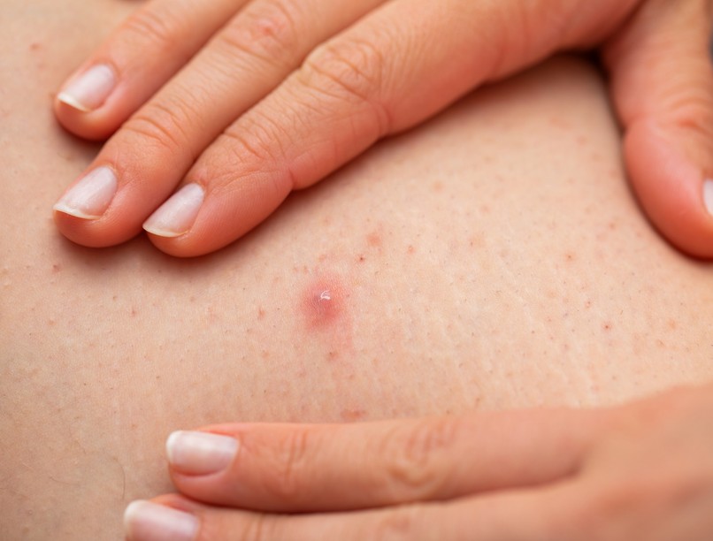 szőrtüszőgyulladás, szőrbenövés, oka, kezelése