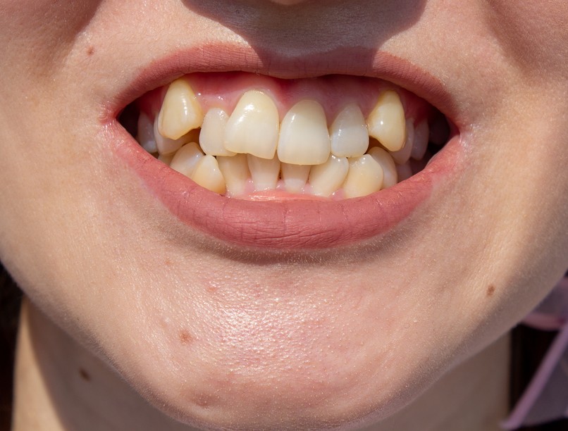 Egyenetlen fogsor, fogászati problémák