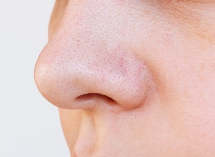 Fekete pöttyök az orron: így tüntetheti el a mitesszereket című cikk nyitóképe