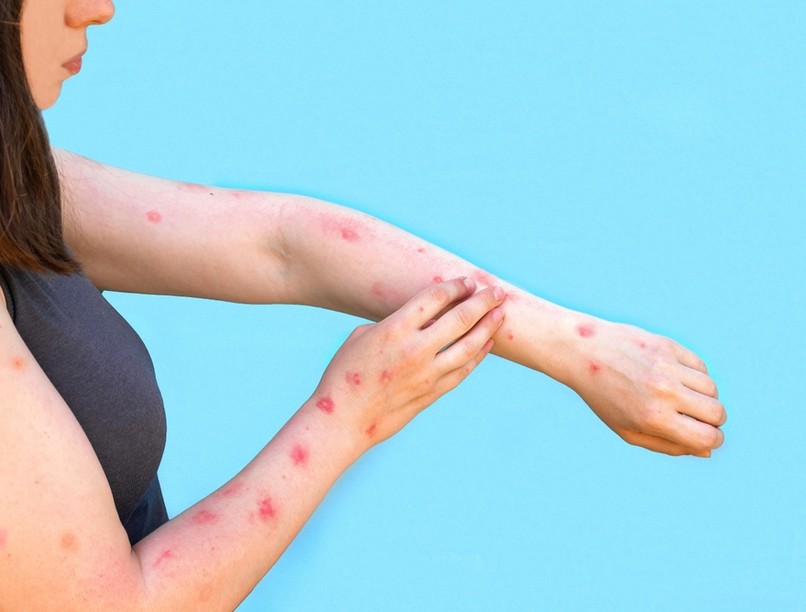 majomhimlő, Tecovirimat, Imvanex, védőoltás