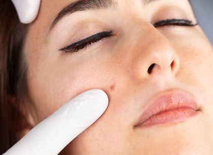 Eltávolítható az arcon lévő anyajegy hegesedés nélkül? című cikk nyitóképe