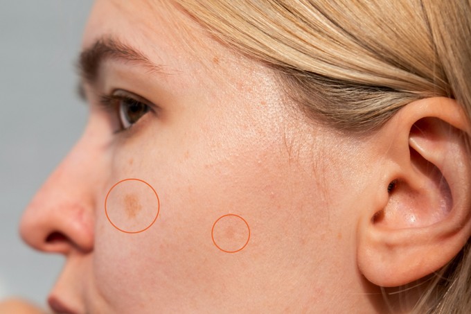 Miért jelenhetnek meg idő előtt az öregségi foltok, és mit kezdhetünk velük? című cikk nyitóképe