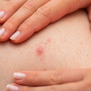 Ha így szőrtelenít, nagyobb az esélye a szőrtüszőgyulladásra című cikk nyitóképe