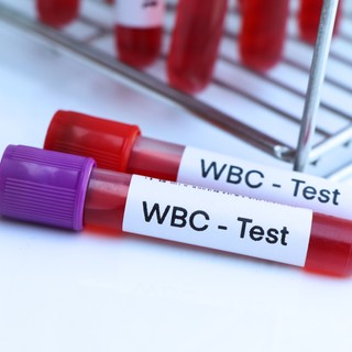 Akár leukémiára is utalhat az, ha magas a leukocyta-száma című cikk nyitóképe