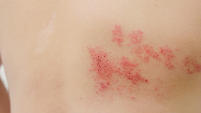 Övsömör (Herpes varicella zoster)