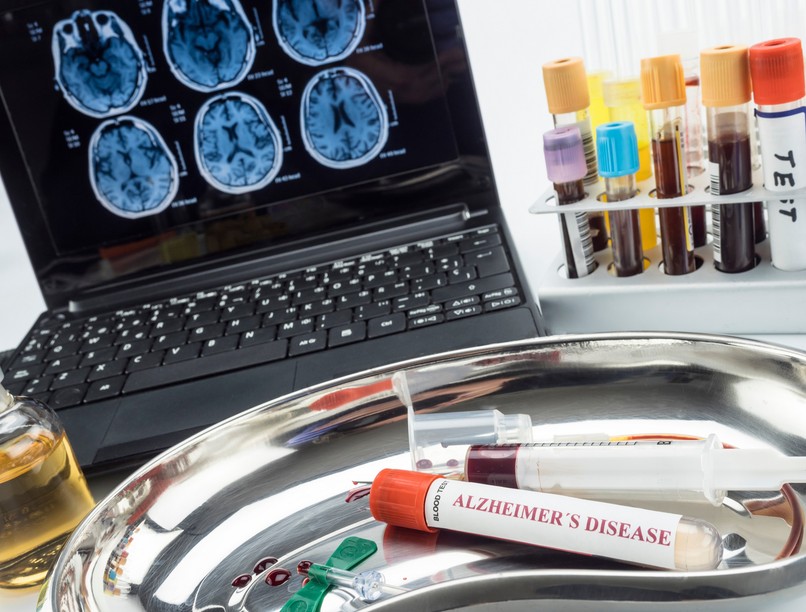 Alzheimer-kór diagnózis vérvizsgálat