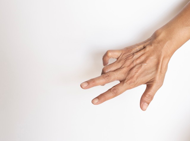 Dupuytren-kontraktúra: a kutatók szerint náluk nagyobb eséllyel alakulhat ki