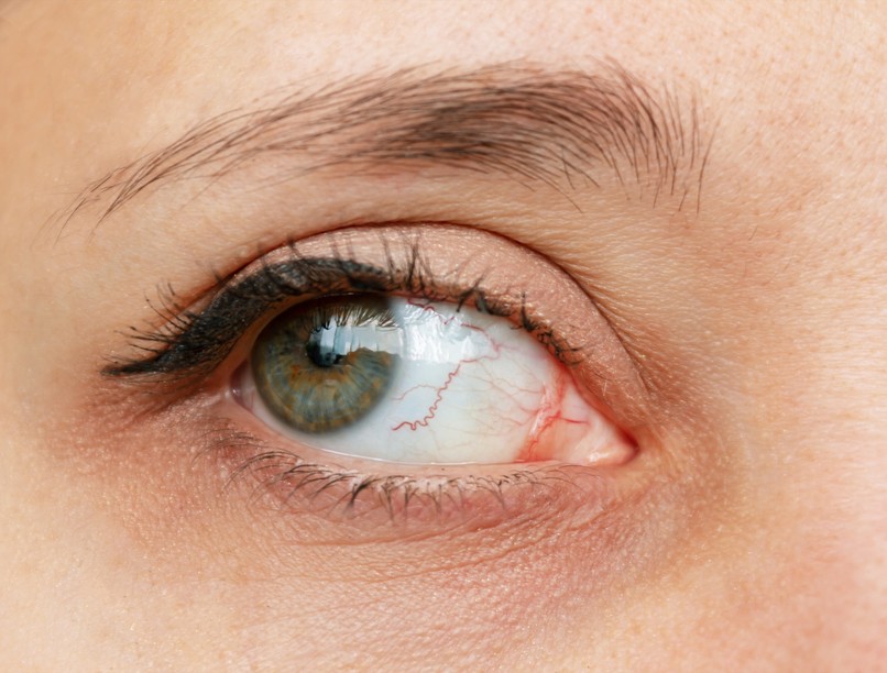 szifilisz fertőzés tünet szem kötőhártya gyulladás