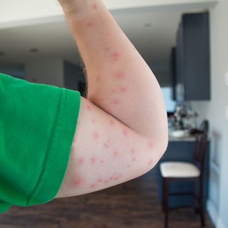 Reggelre tele lett csípésnyomokkal? Innen tudhatja, mi okozta című cikk nyitóképe