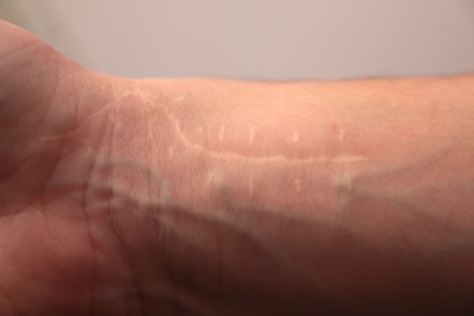 Meglepő, de a seb nem felejt! Egy régi heg is okozhat derékfájást, székrekedést, vagy akár meddőséget című cikk nyitóképe