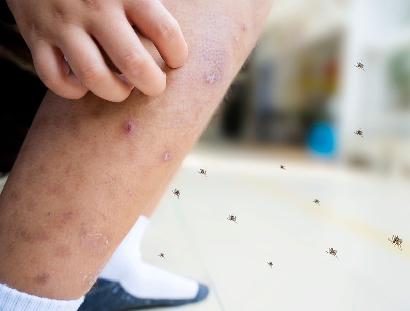 allergia szúnyogcsípés gyerek