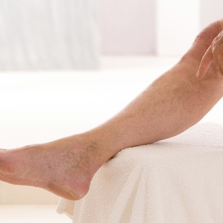 Vénafalgyulladás (tromboflebitisz) tünetei, vizsgálata és kezelése című cikk nyitóképe