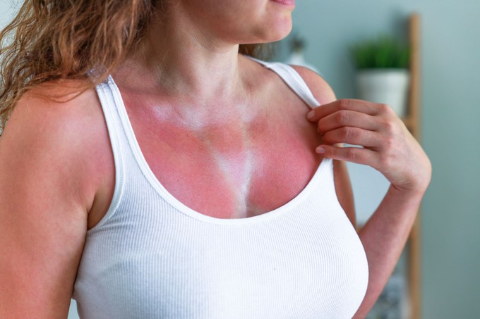 Ezekkel az otthoni gyógymódokkal megszabadulhat a napégés fájdalmától című cikk nyitóképe