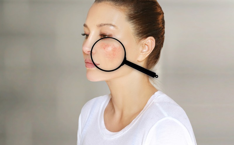 Ilyen különös alakú bőrpírral is elárulhatja magát egy betegség!