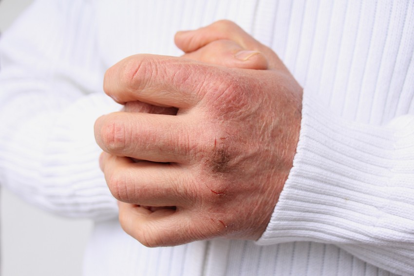 A cukorbetegség legtöbbször lappangva, alattomosan alakul ki. A szakorvos szerint ezek lehetnek az árulkodó tünetek.