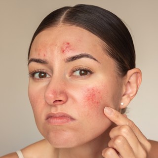 Miért félünk a lepkehimlőtől? című cikk nyitóképe