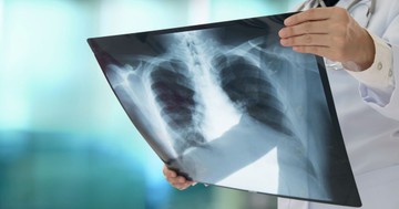  Tüdőgyulladás: változatos és néha furcsa tünetekkel is járhat 