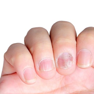 Beau-féle vonalak kialakulásának oka, tünetei és kezelése című cikk nyitóképe