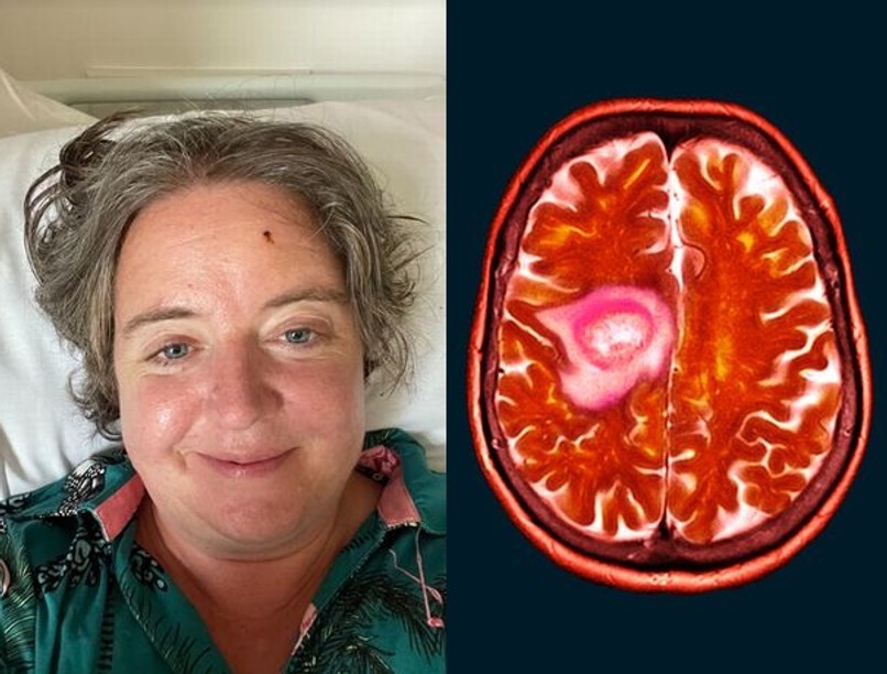 glioblasztóma, agydaganat, gerincvelő, rák, tumor, memória 