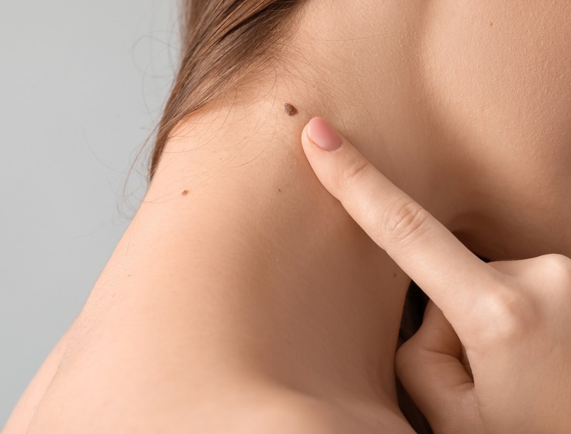 kóros elváltozás anyajegy, bőrrák daganat