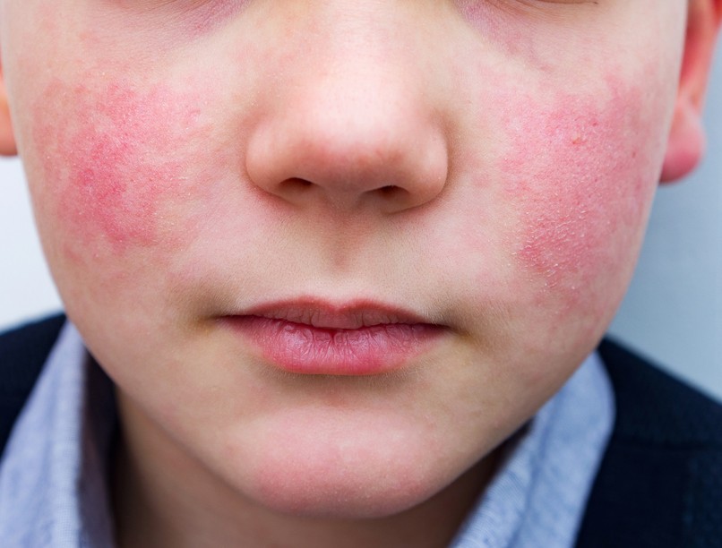 lepkehimlő, ötötdik betegség