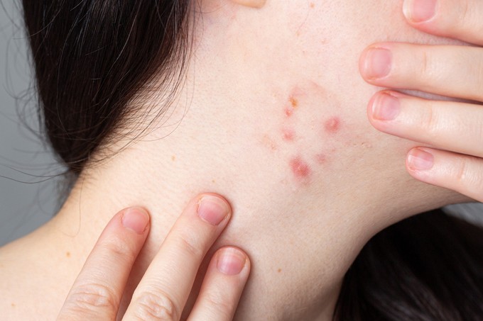 Pattanások a nyakon: nem véletlenül jelennek meg – ezt üzenheti a szervezete című cikk nyitóképe