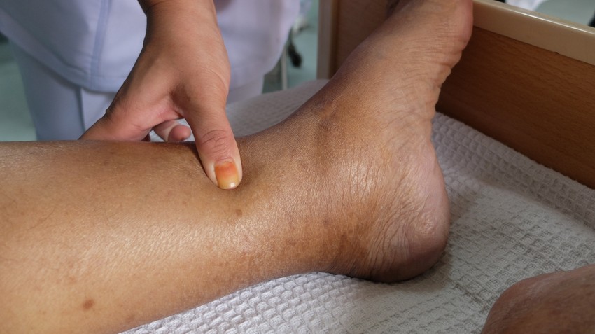 Az ödéma nem egy betegség, hanem egy tünet. Az ödémás láb jelensége mögött több dolog is meghúzódhat, többek között szív- és érrendszeri, vese- vagy endokrinológiai betegségek is állhatnak.