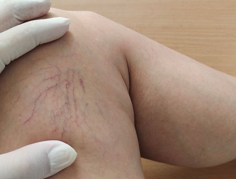 elhanyagolt visszérgyulladás trombózis visszeres láb