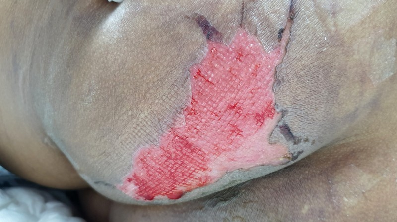 Felfekvés (decubitus): megelőzés, tünetek, kezelés és a legújabb terápiás lehetőségek