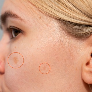 Miért jelenhetnek meg idő előtt az öregségi foltok, és mit kezdhetünk velük? című cikk nyitóképe