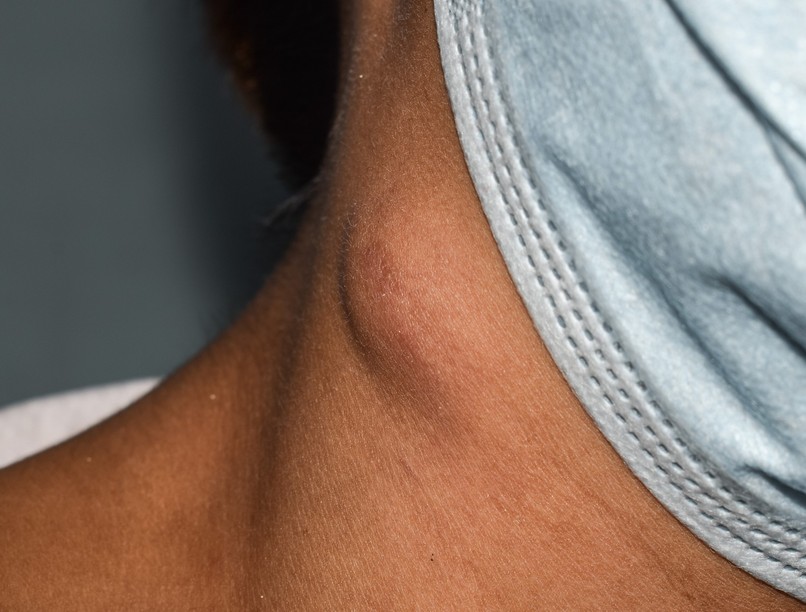 Csomó bőr alatt nyirokrák