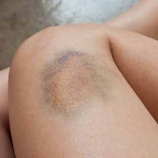 Kék-zöld foltok a lábon, ínyvérzés fogmosáskor - ezek a vérzékenység tünetei című cikk nyitóképe